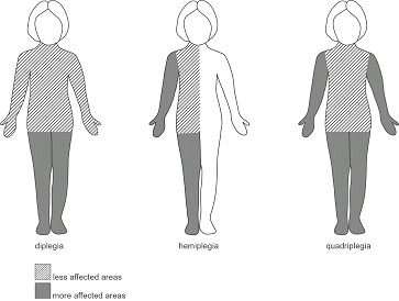    2013 2014 Cerebral_palsy (3).jpg